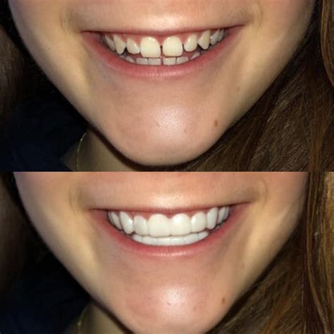 The Secret to a Celebrity Smile: Magic Teeth Brace Instant Veneers